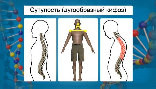 определение сутулости