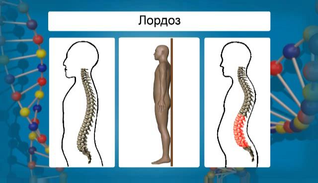 определение лордоза норма