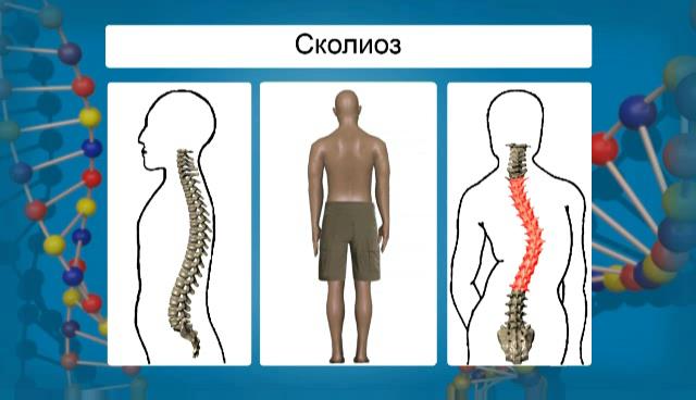 определение сколиоза