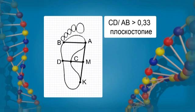 наличие плоскостопия определение