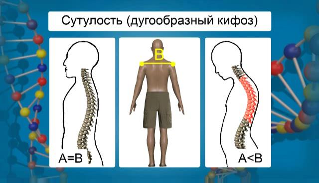 сутулость есть