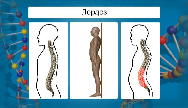 лордоз нарушение